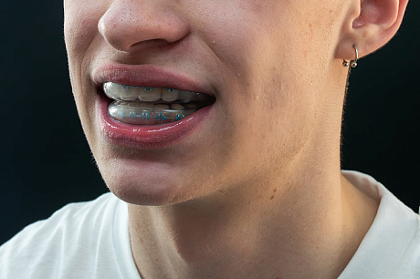 Для спортсменов с брекетами Sky Ortho