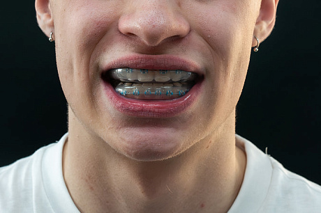 Для спортсменов с брекетами Sky Ortho